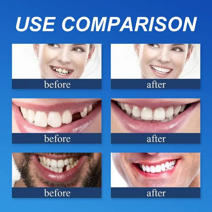 SecureSmile Custom-Fit Full Dentures Comfort Solution